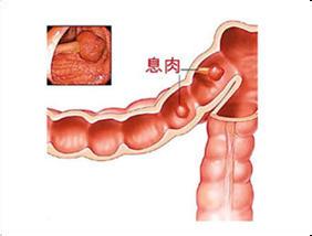 莆田治療腸息肉醫(yī)院